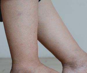 lipedema-2
