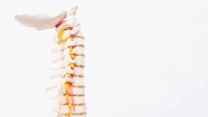 lordosis