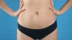 diastasis-2