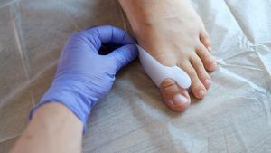 hallux-valgus-3