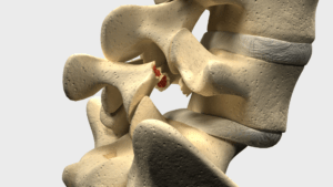 espondilolistesis-2