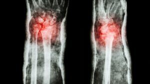 fractura-colles